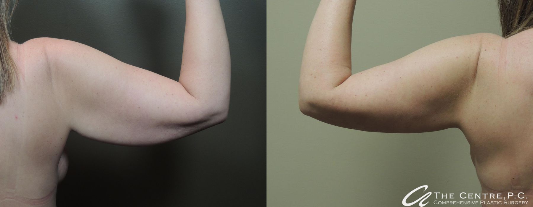 Arm Lift - Thumbnail 2