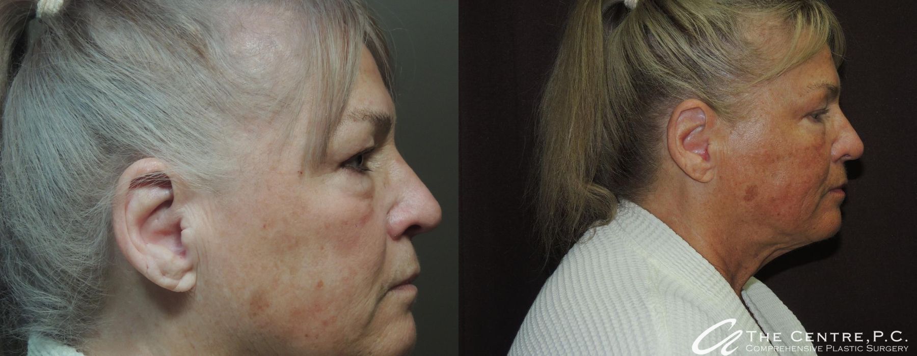 Before and after Blepharoplasty case 13107 - Angle 2