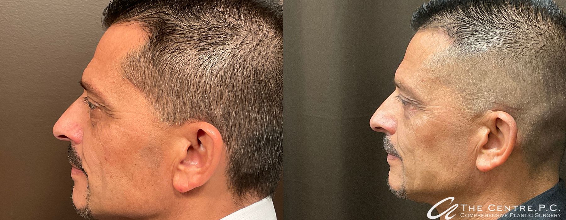 Before and after Blepharoplasty case 13974 - Angle 3