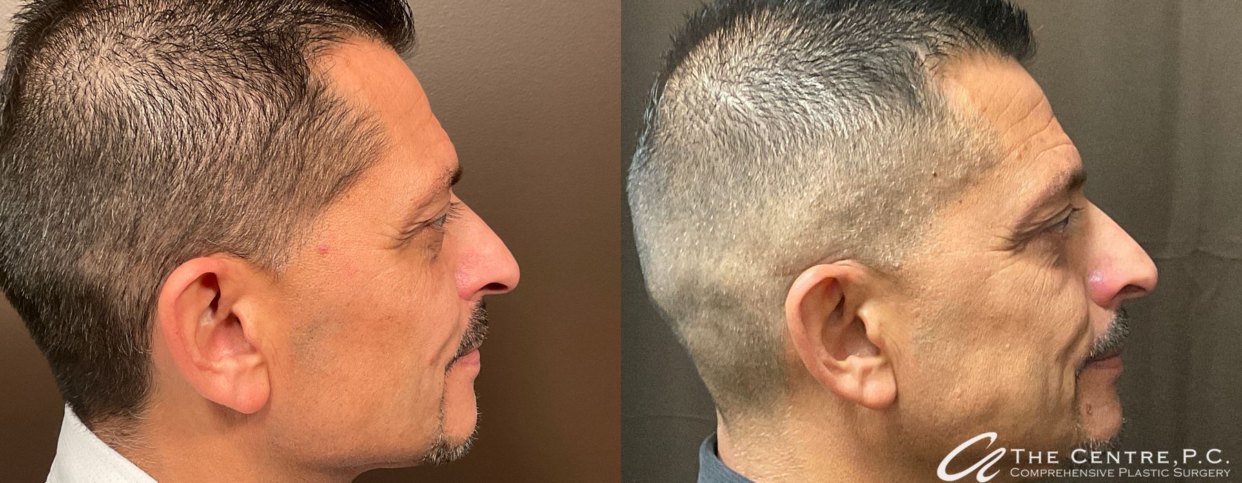 Before and after Blepharoplasty case 13974 - Angle 2