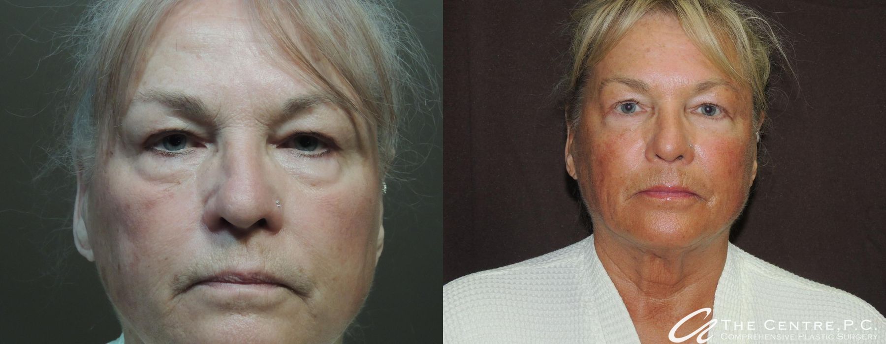 Before and after procedure result