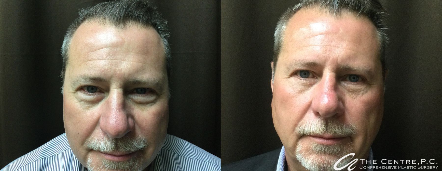 Before and after procedure result