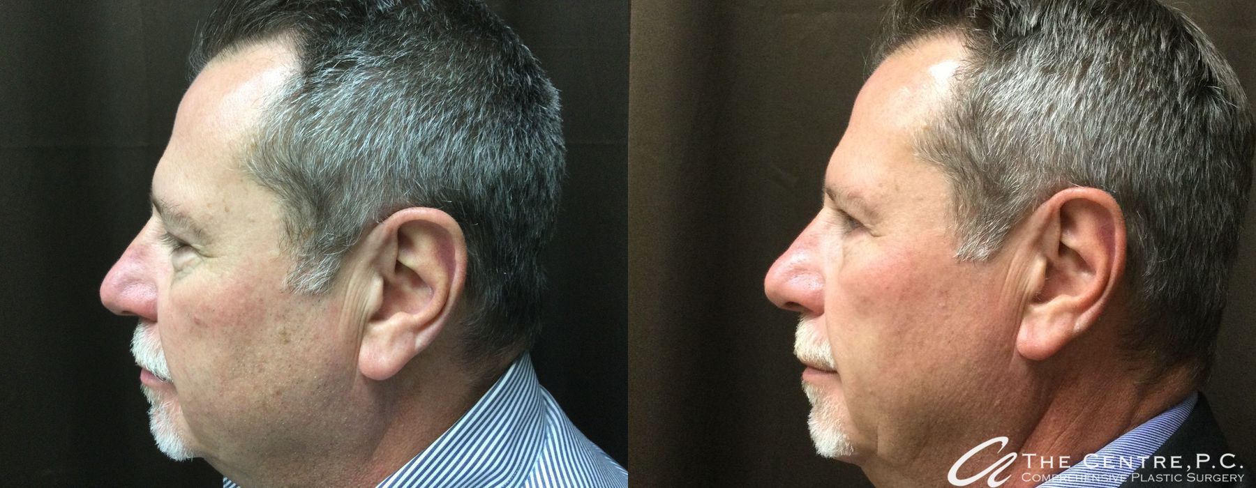 Before and after Blepharoplasty case 13128 - Angle 3