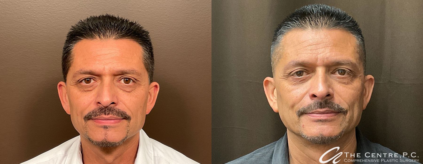 Before and after procedure result