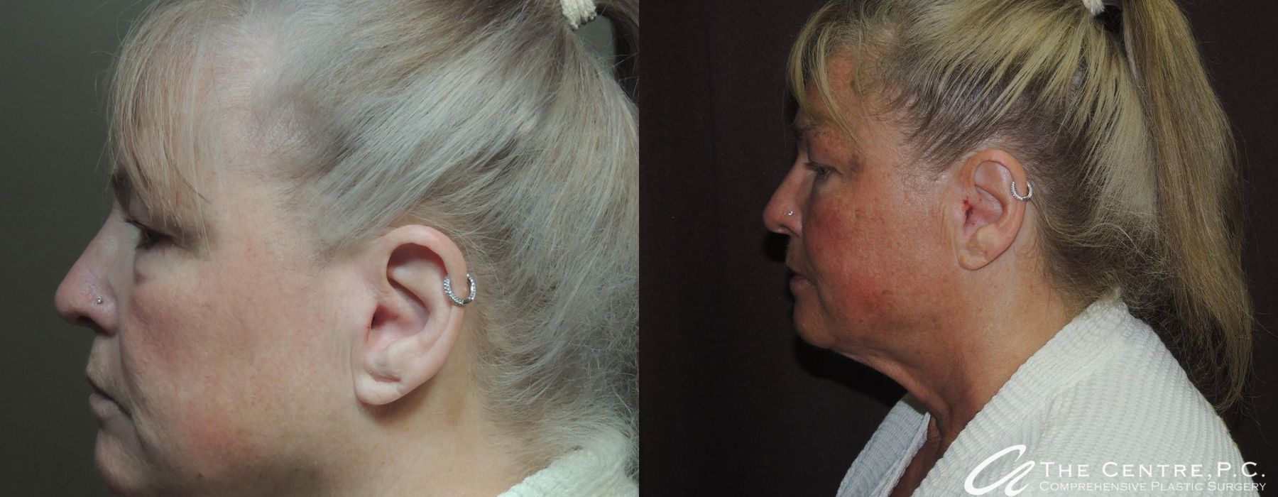 Before and after Blepharoplasty case 13107 - Angle 3