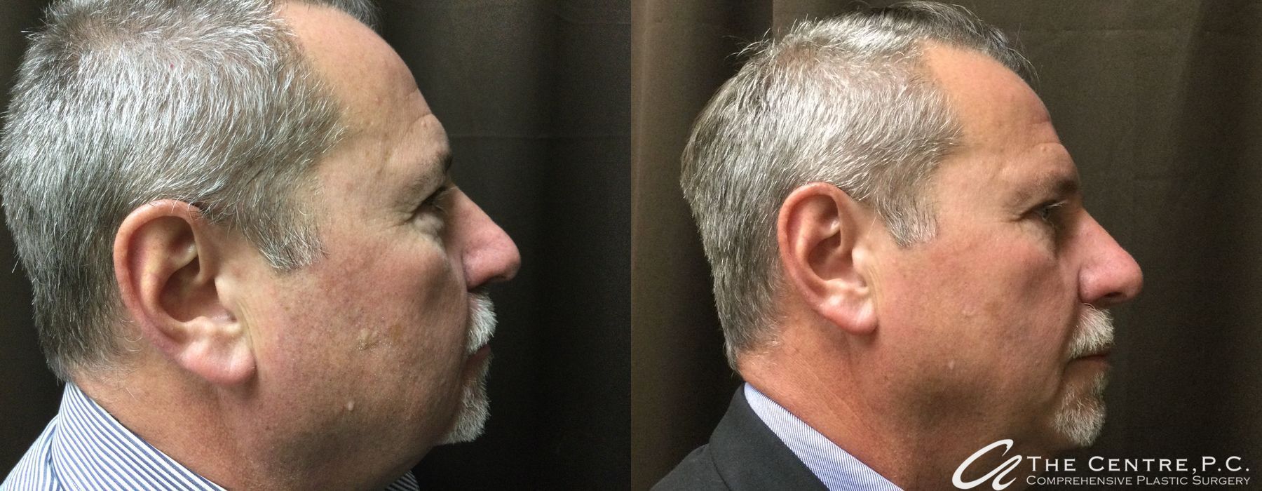 Before and after Blepharoplasty case 13128 - Angle 2