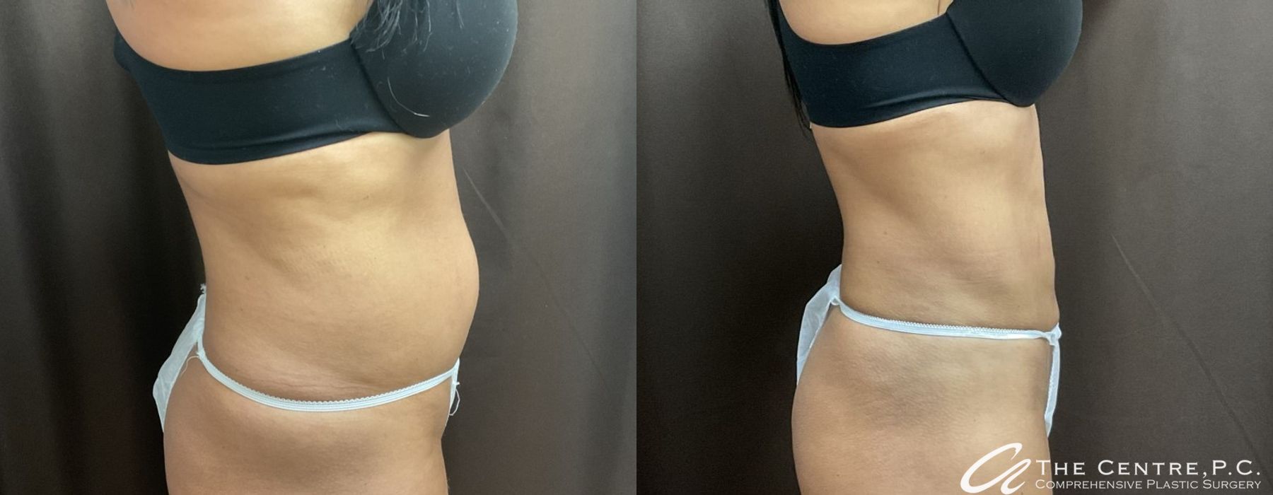 Before and after Body Contouring case 9959 - Angle 2