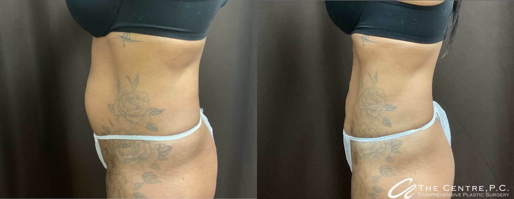 Before and after Body Contouring case 9959 - Angle 3