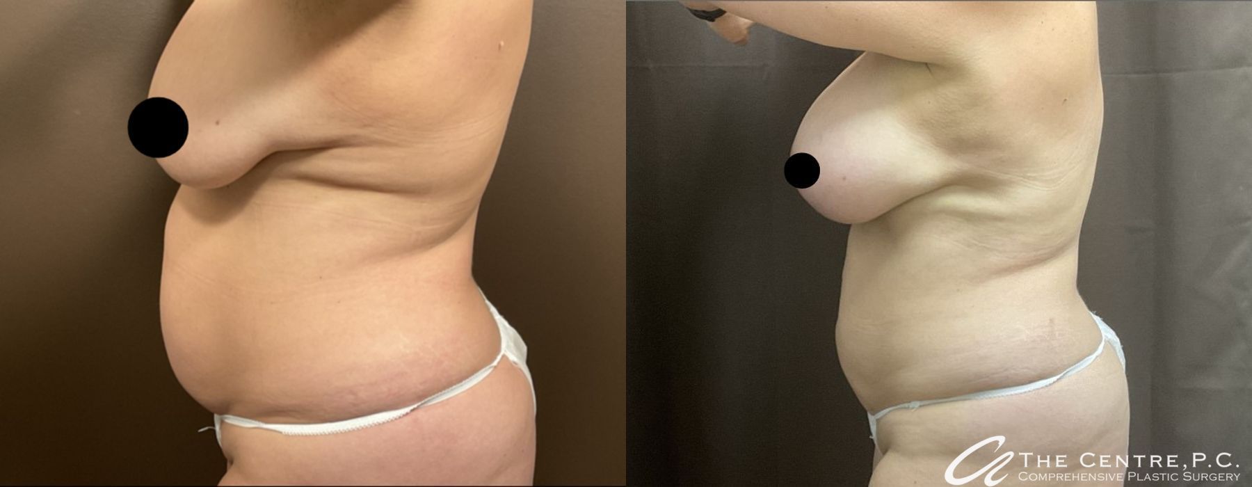 Body Contouring - Thumbnail 2