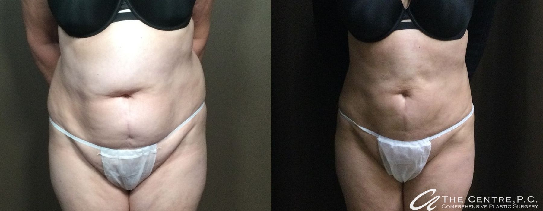 Body Contouring - Case 3261