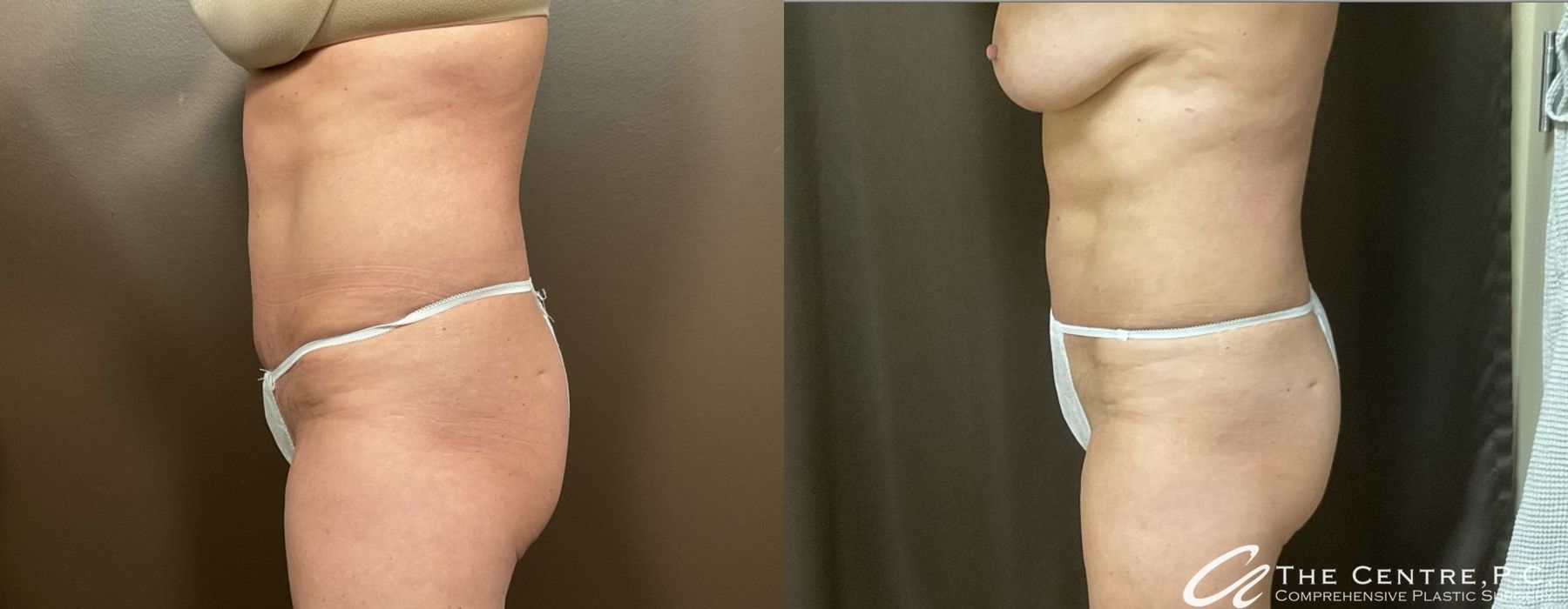 Body Contouring - Thumbnail 2
