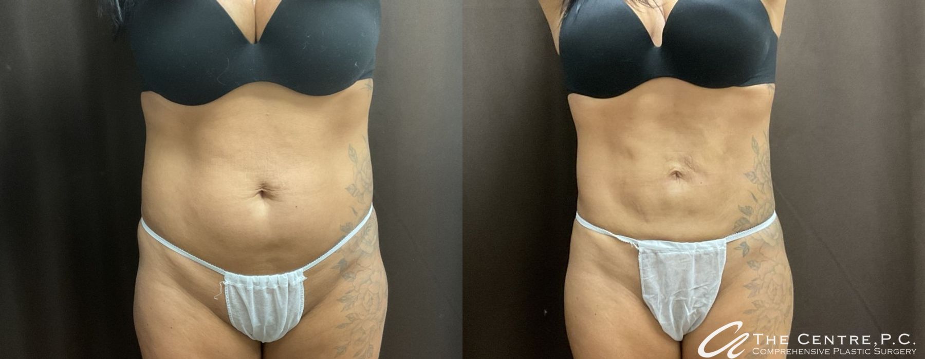 Before and after Body Contouring case 9959