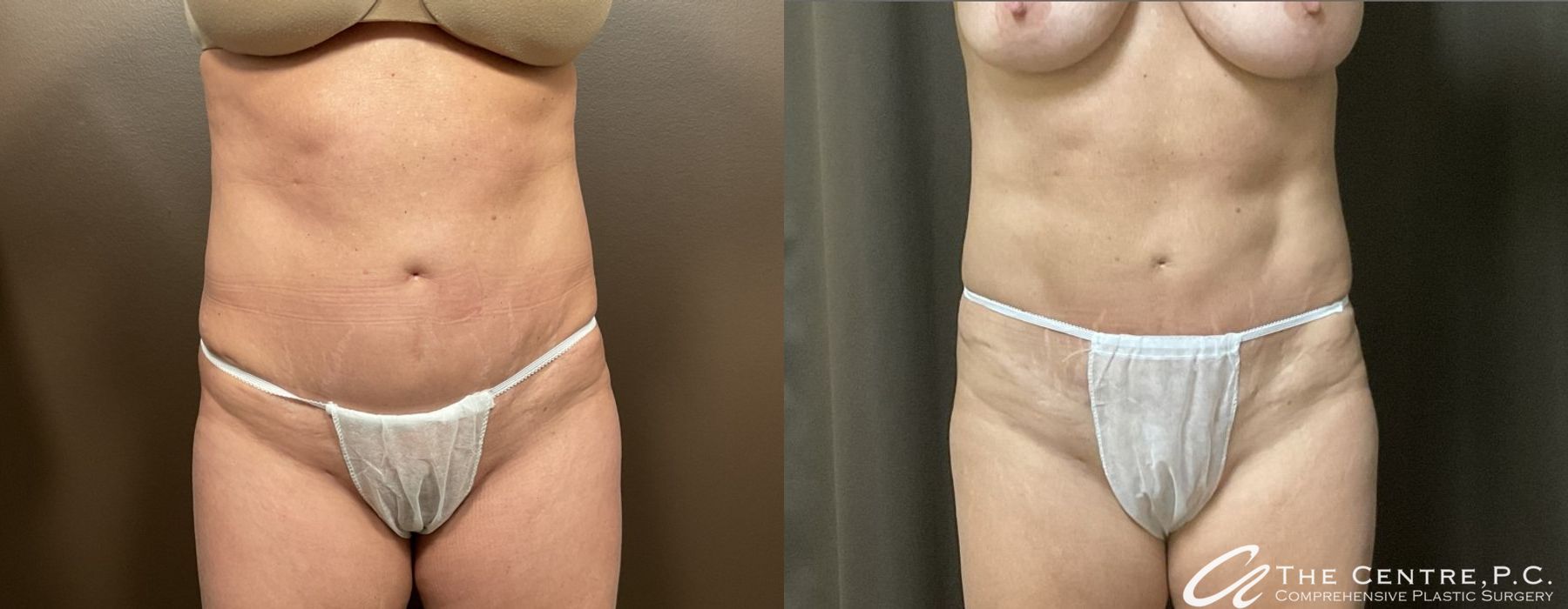 Body Contouring - Case 3263