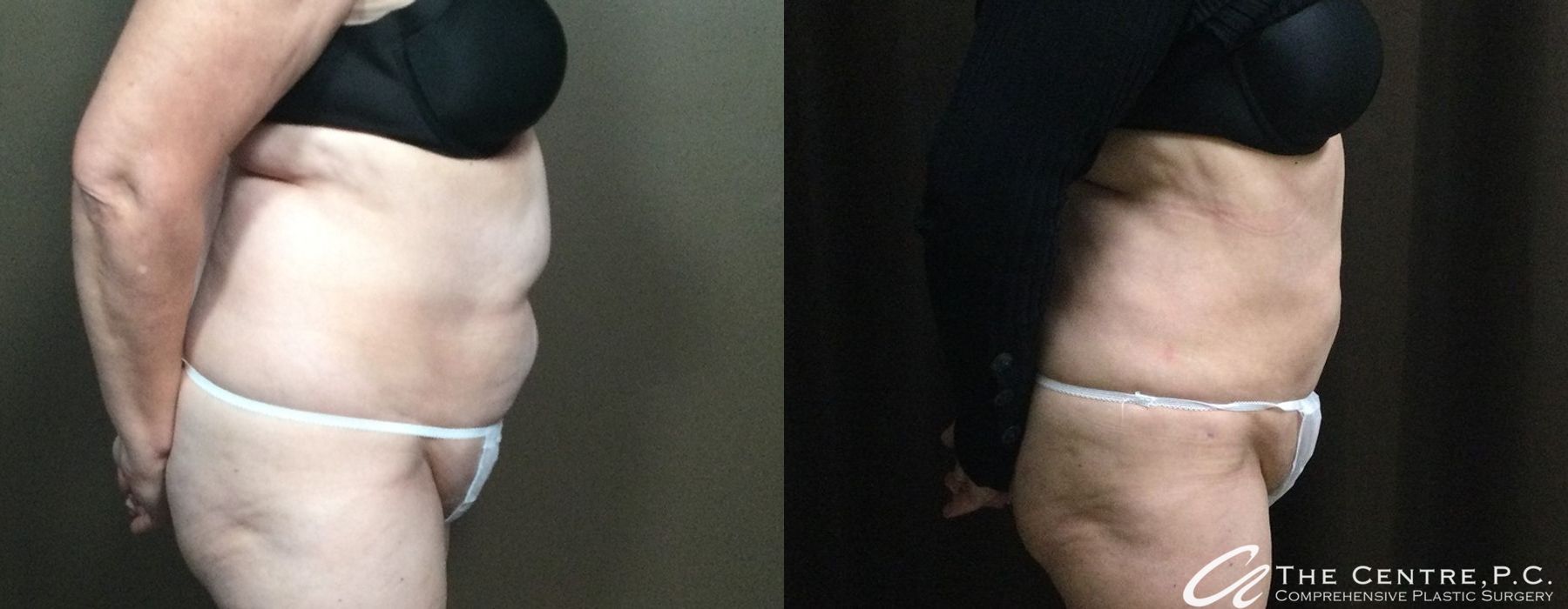 Body Contouring - Thumbnail 3