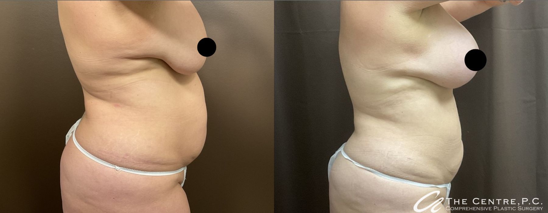 Body Contouring - Thumbnail 3