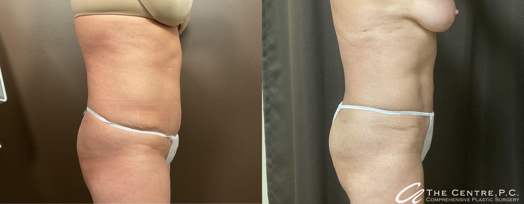 Body Contouring - Thumbnail 3