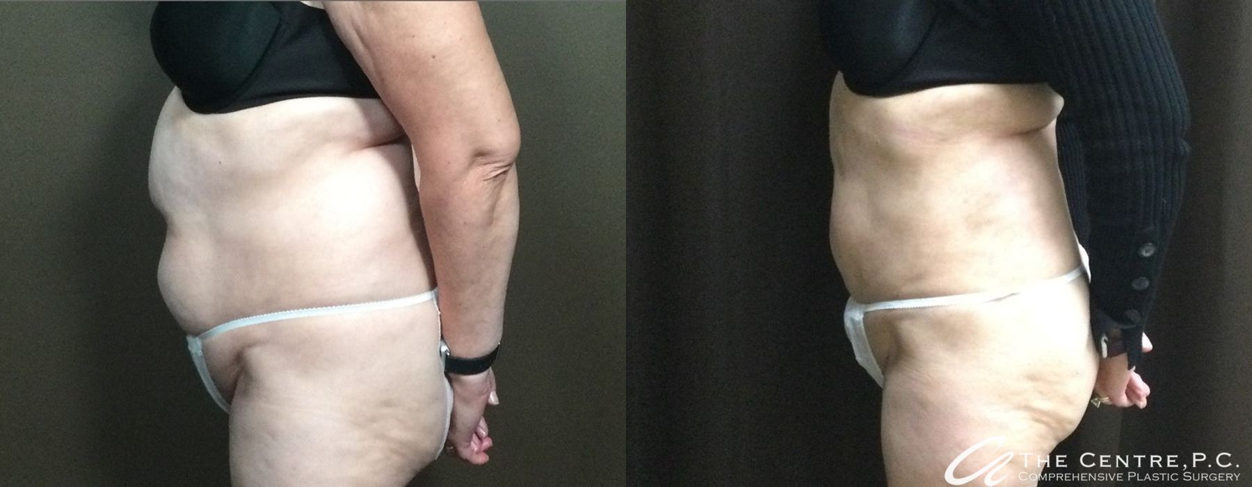 Body Contouring - Thumbnail 2