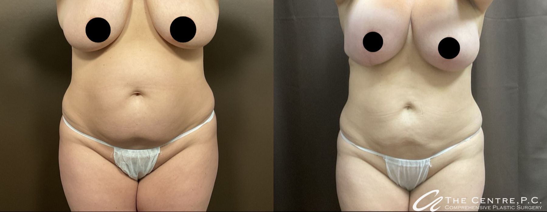 Body Contouring - Case 3788