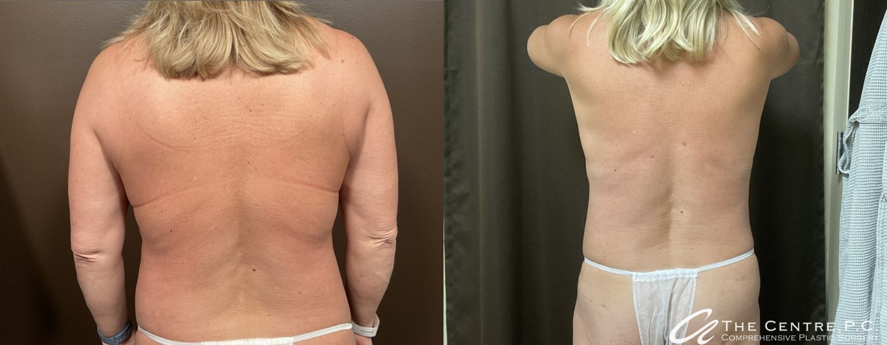 Body Contouring - Thumbnail 4