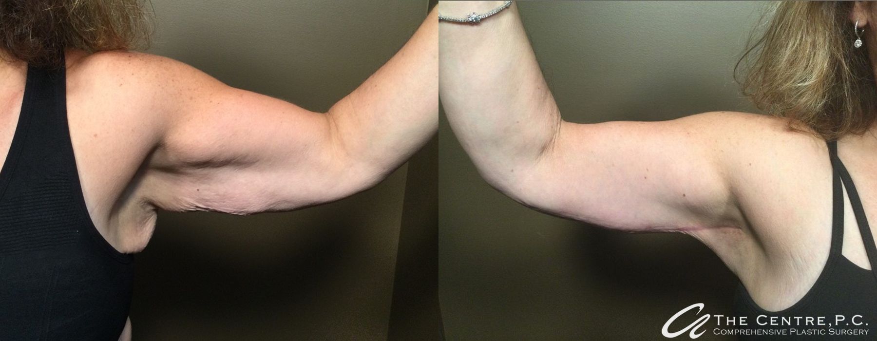 Before and after Featured Cases case 9958 - Angle 2