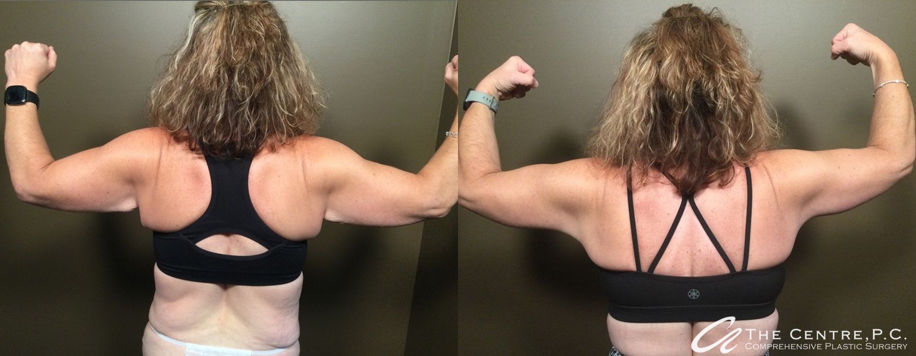 Before and after Featured Cases case 9958 - Angle 3