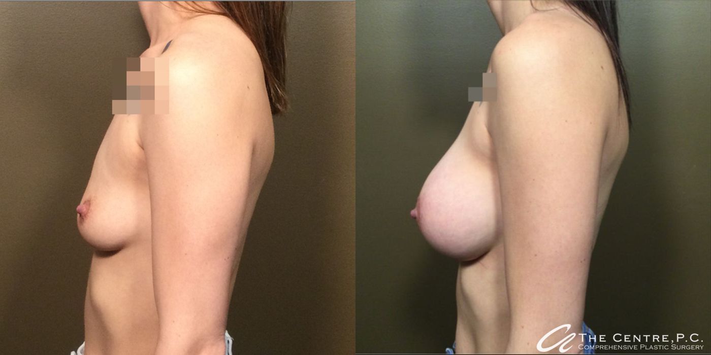 Before and after Breast Augmentation case 10985 - Angle 3