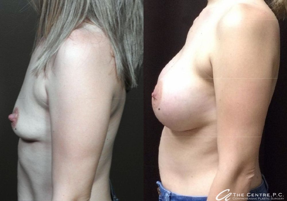 Before and after Breast Augmentation case 9974 - Angle 3