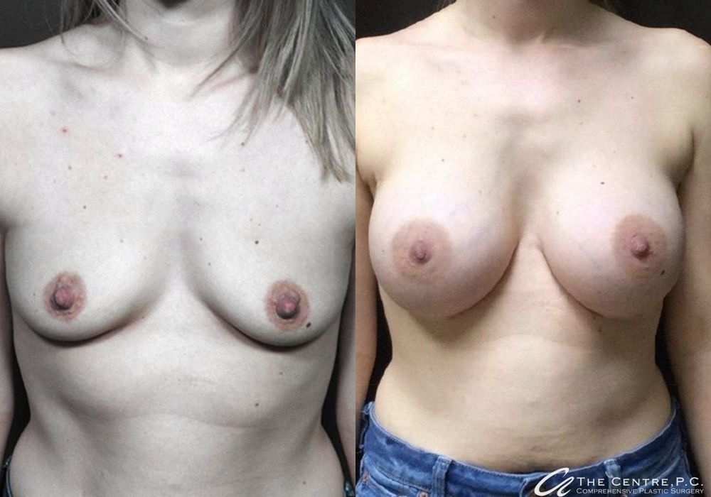 Before and after Breast Augmentation case 9974