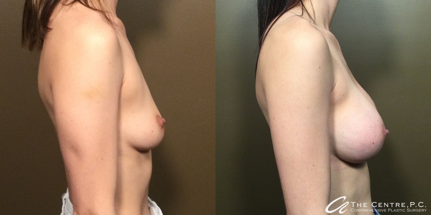 Before and after Breast Augmentation case 10985 - Angle 2