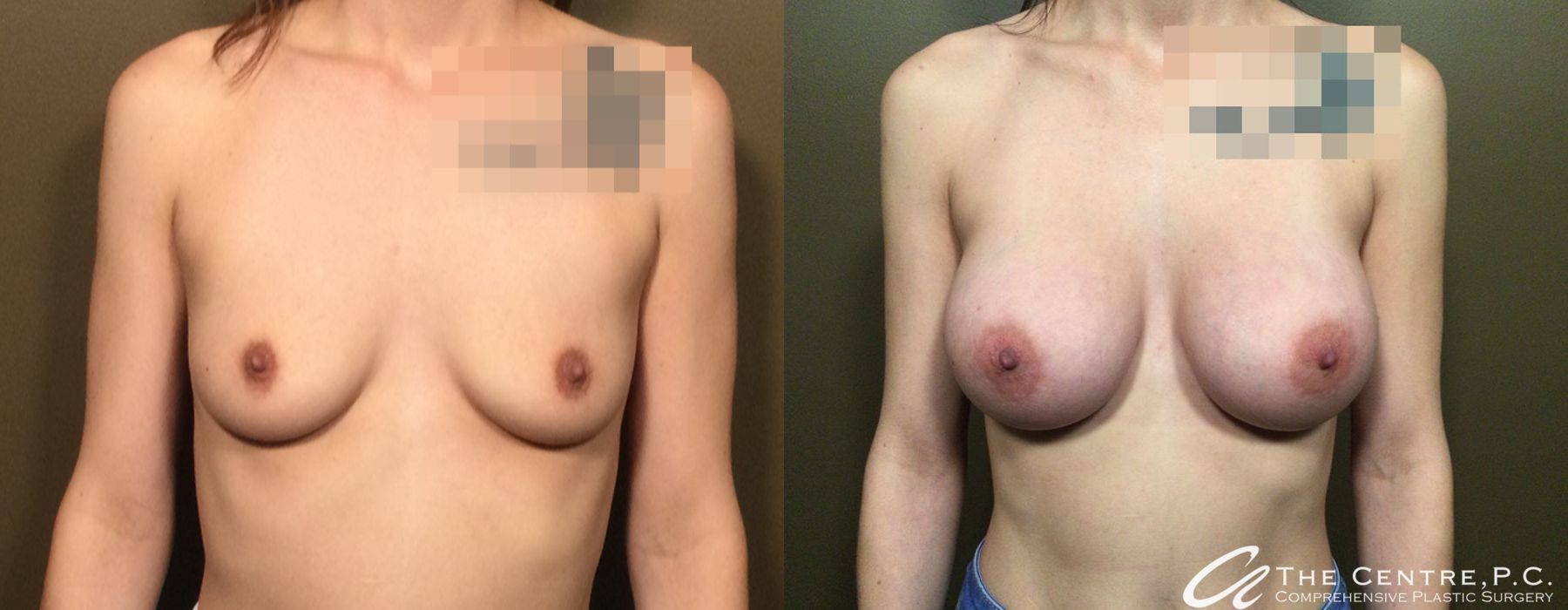 Before and after Breast Augmentation case 10985
