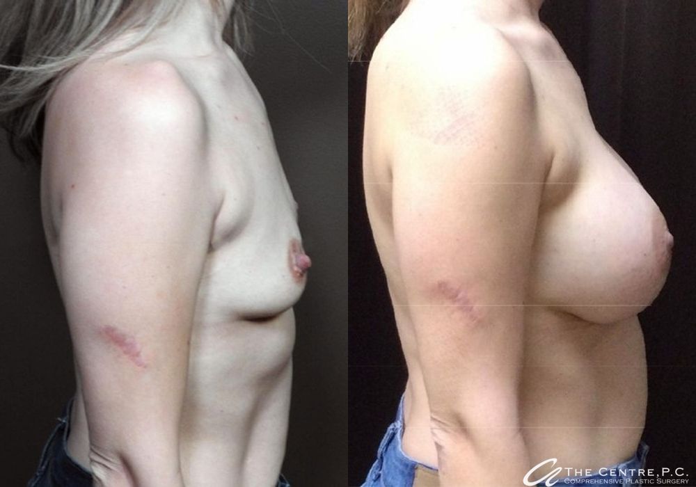 Before and after Breast Augmentation case 9974 - Angle 2