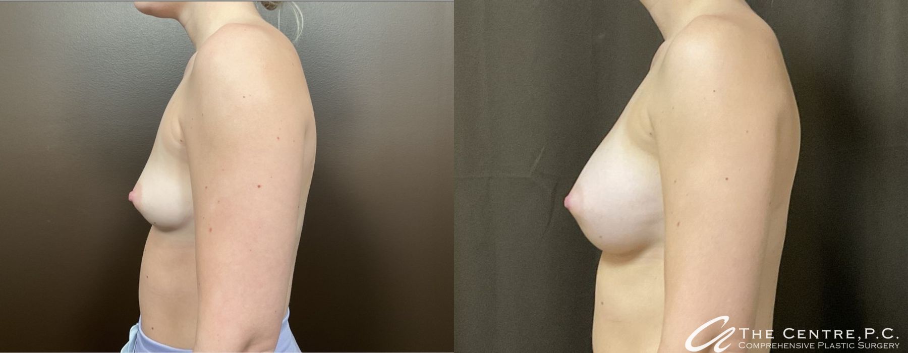 Before and after Breast Augmentation case 9963 - Angle 3