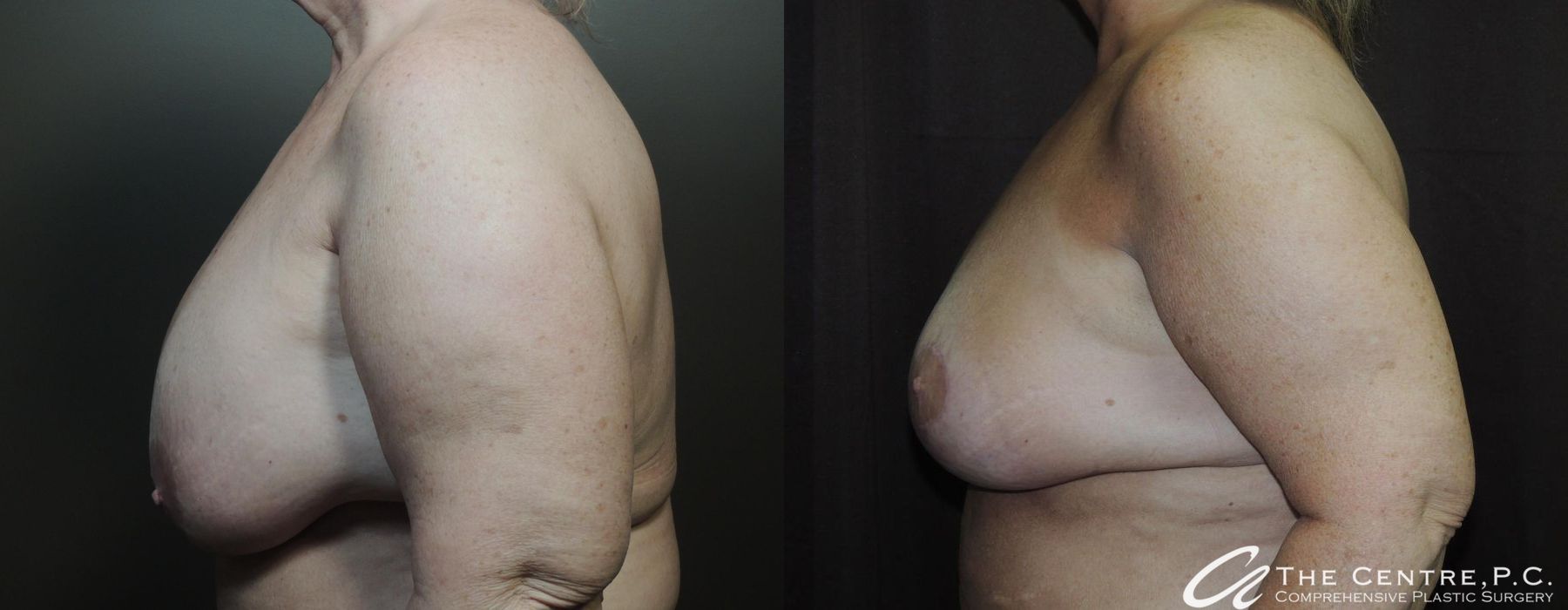 Before and after Breast Augmentation with Lift case 13108 - Angle 3