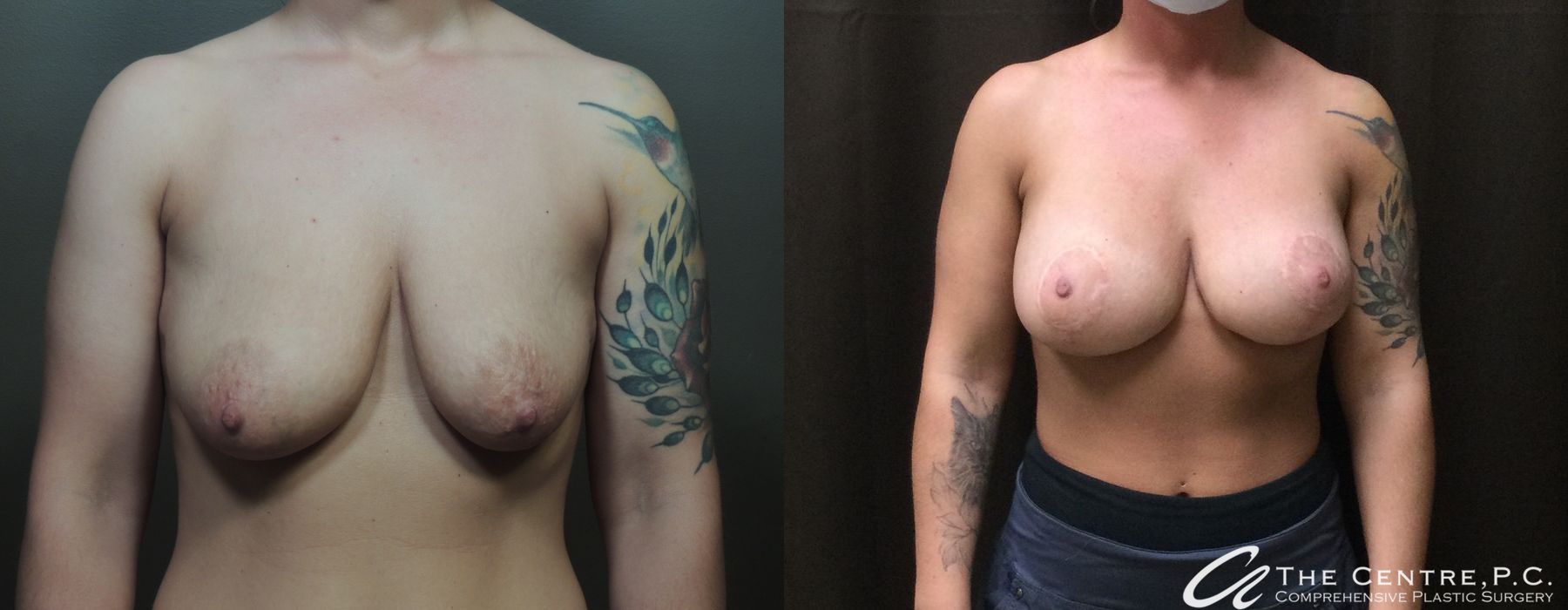 Before and after procedure result