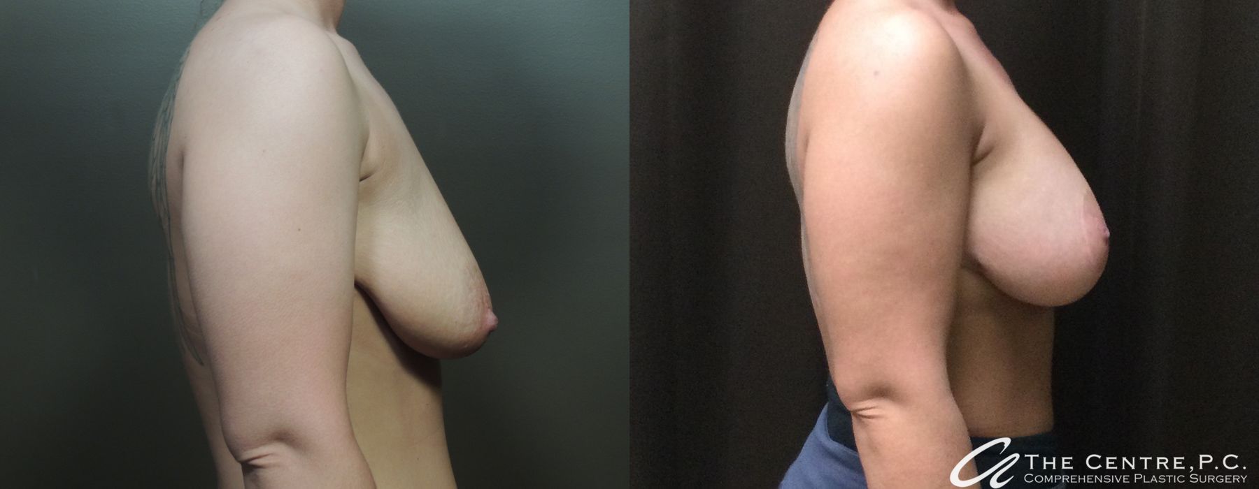 Before and after Breast Augmentation with Lift case 12918 - Angle 3