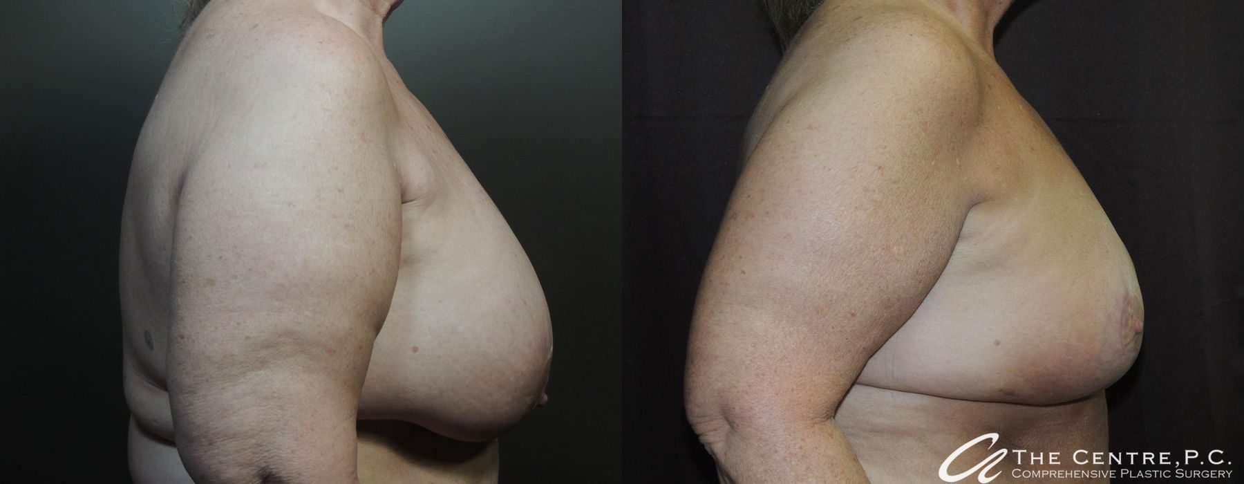Before and after Breast Augmentation with Lift case 13108 - Angle 2