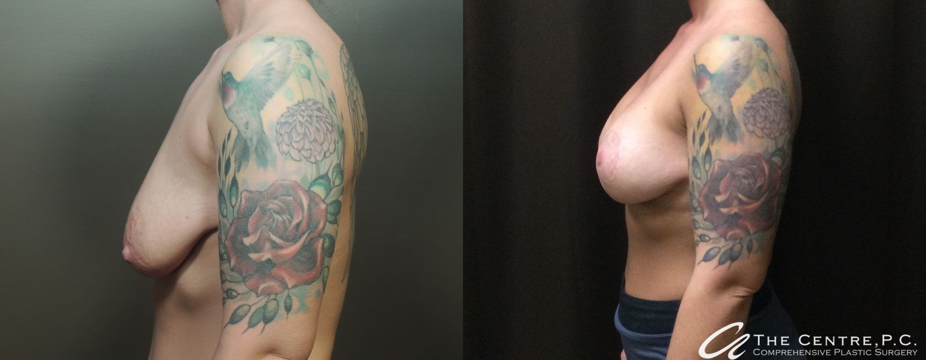 Before and after Breast Augmentation with Lift case 12918 - Angle 2