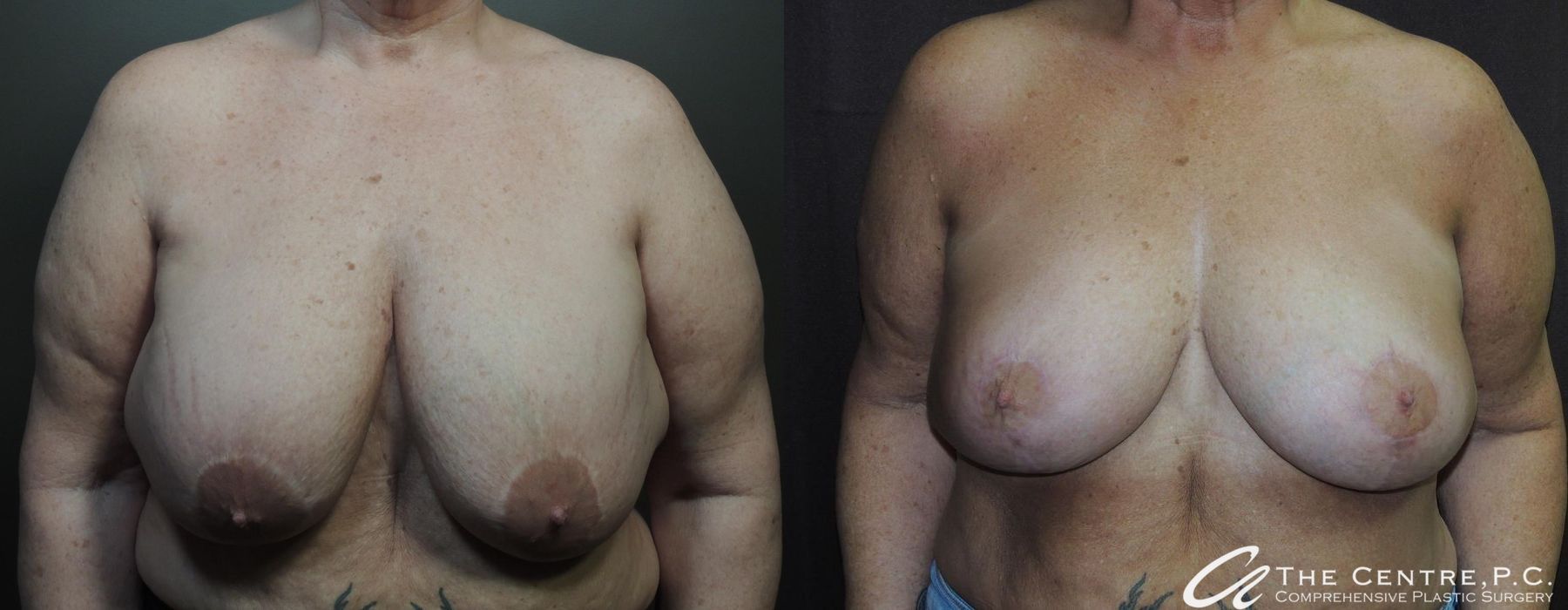 Before and after procedure result