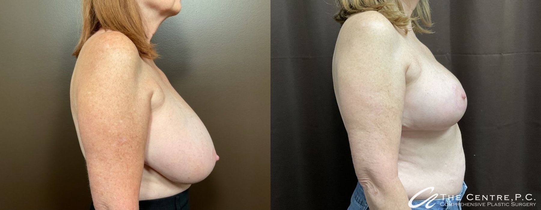 Before and after Breast Reduction case 9960 - Angle 2