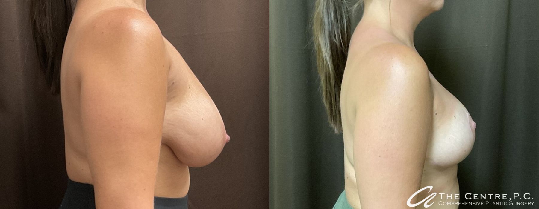 Before and after Breast Reduction case 9967 - Angle 2