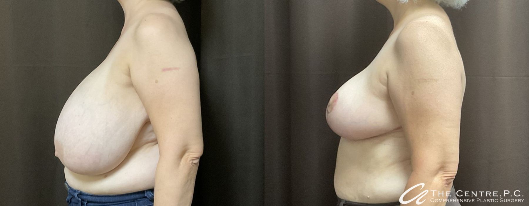 Before and after Breast Reduction case 9968 - Angle 2