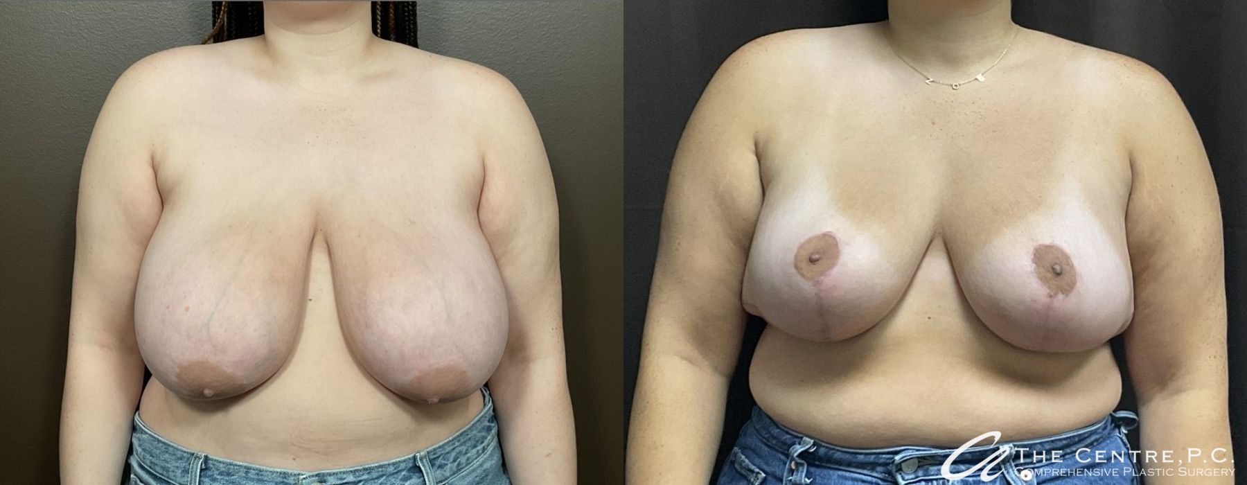 Before and after Breast Reduction case 9970