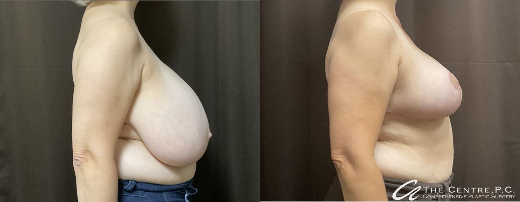 Before and after Breast Reduction case 9968 - Angle 3