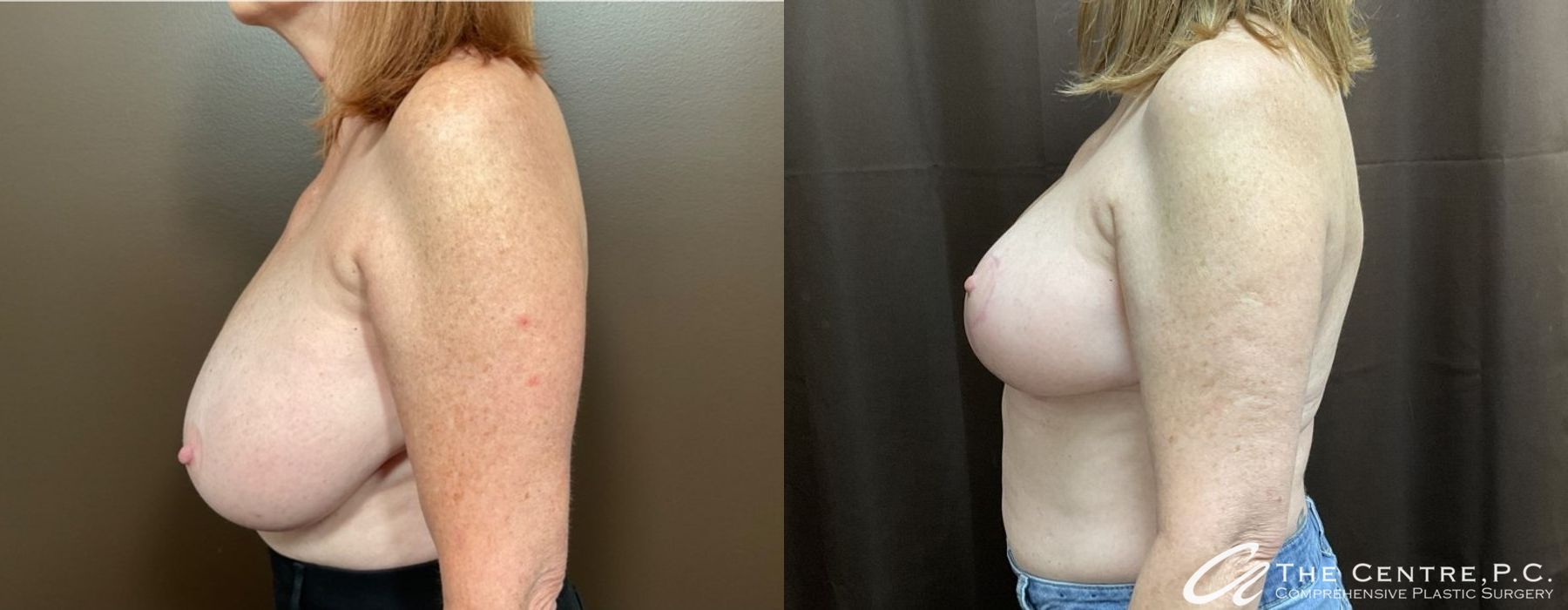 Before and after Breast Reduction case 9960 - Angle 3
