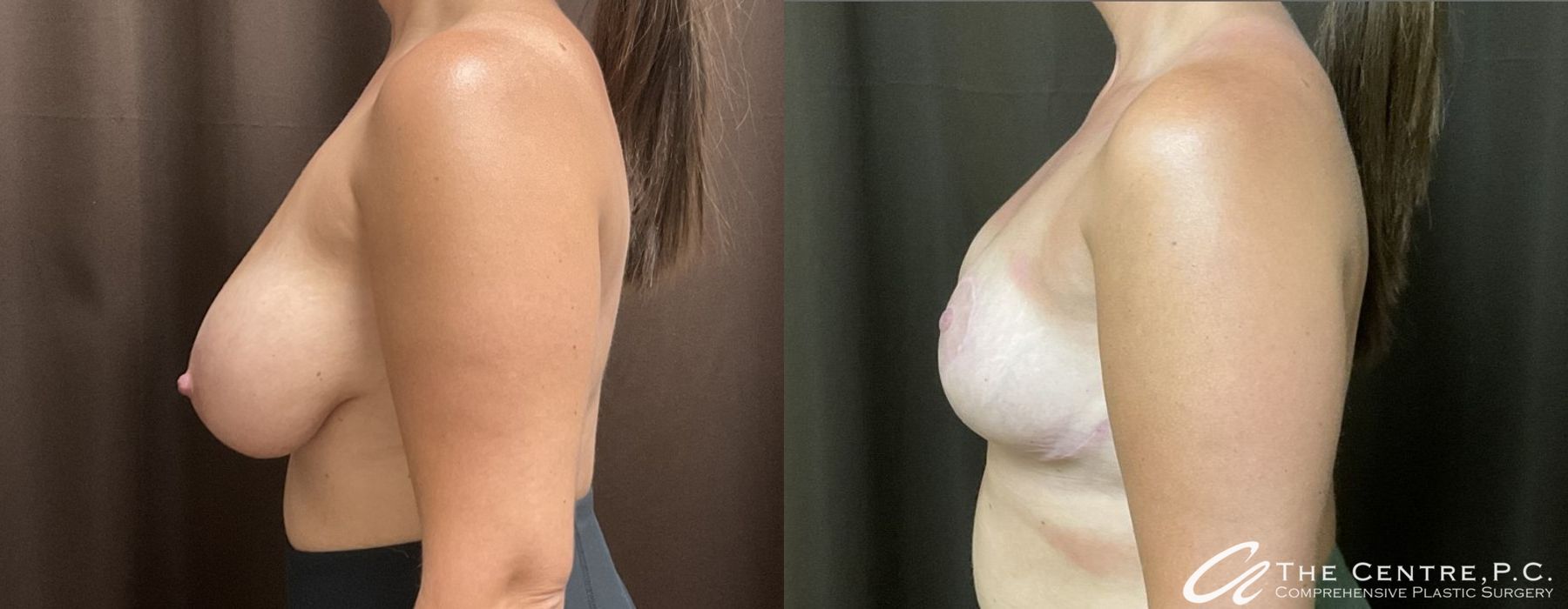 Before and after Breast Reduction case 9967 - Angle 3