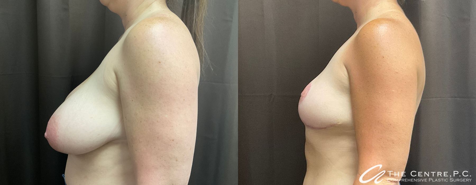 Before and after Breast Reduction case 12312 - Angle 3