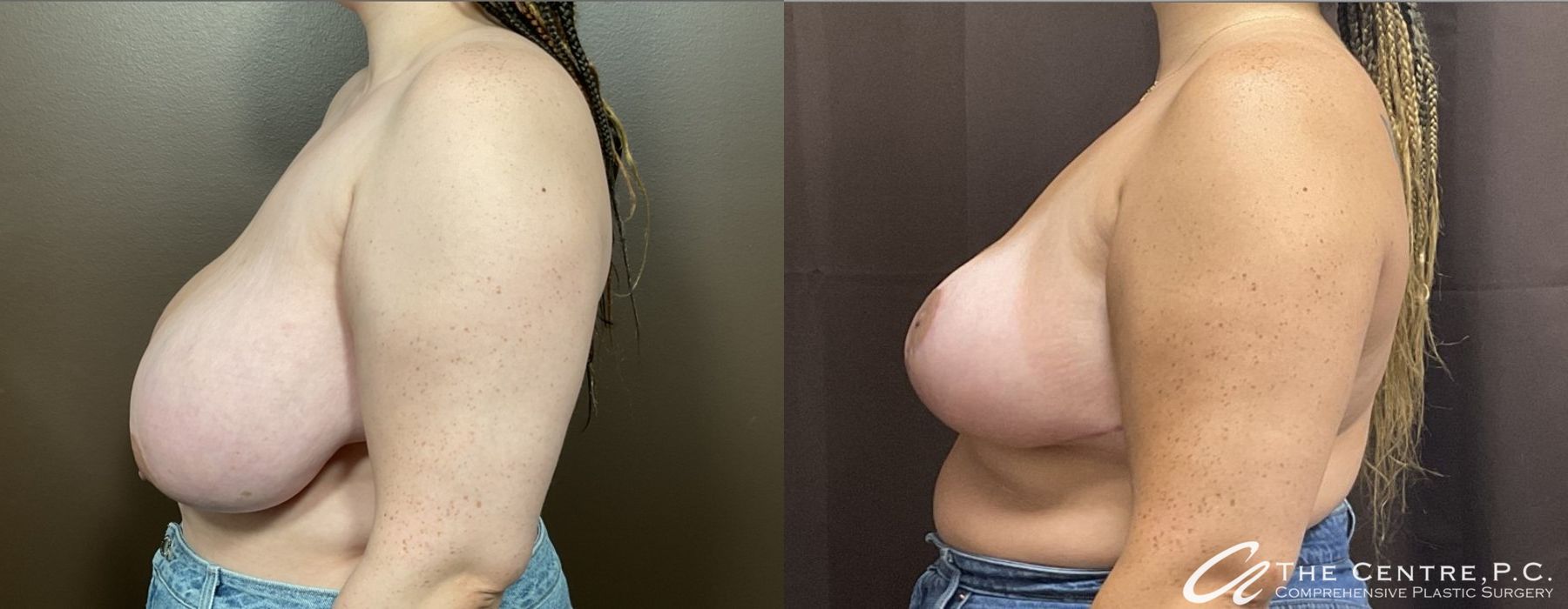 Before and after Breast Reduction case 9970 - Angle 3