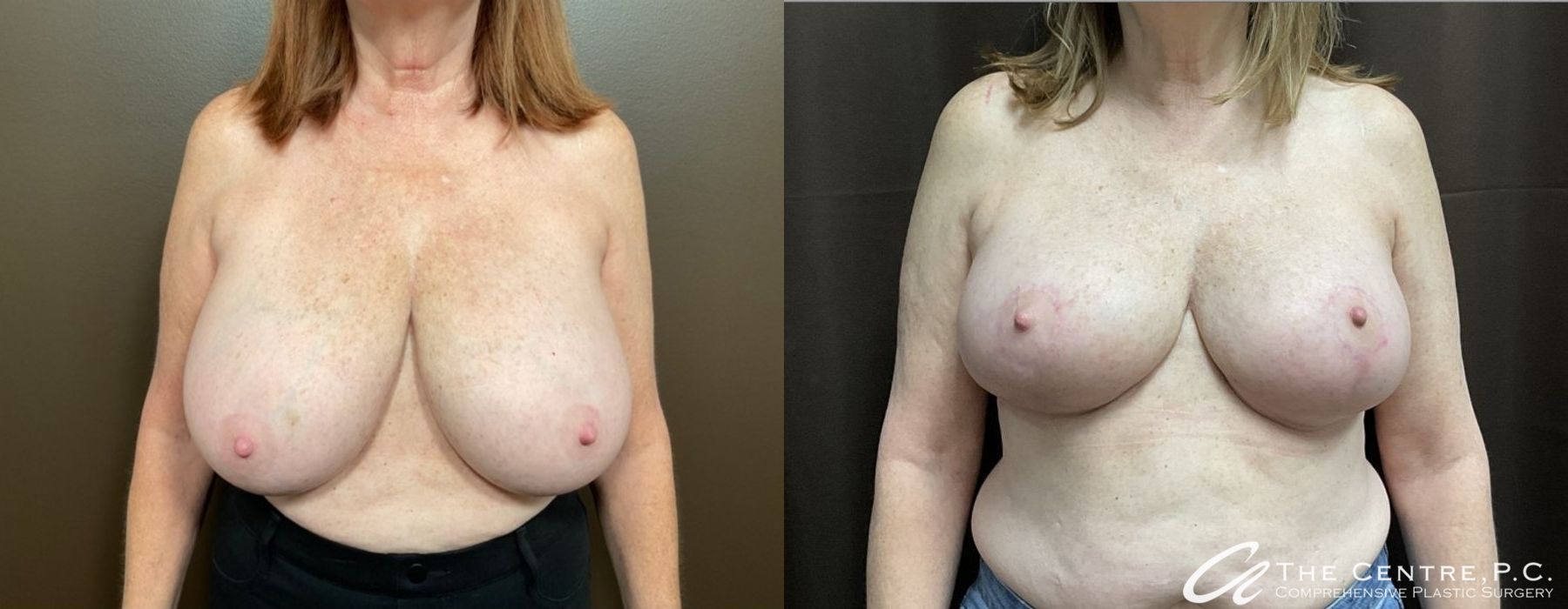 Before and after Breast Reduction case 9960
