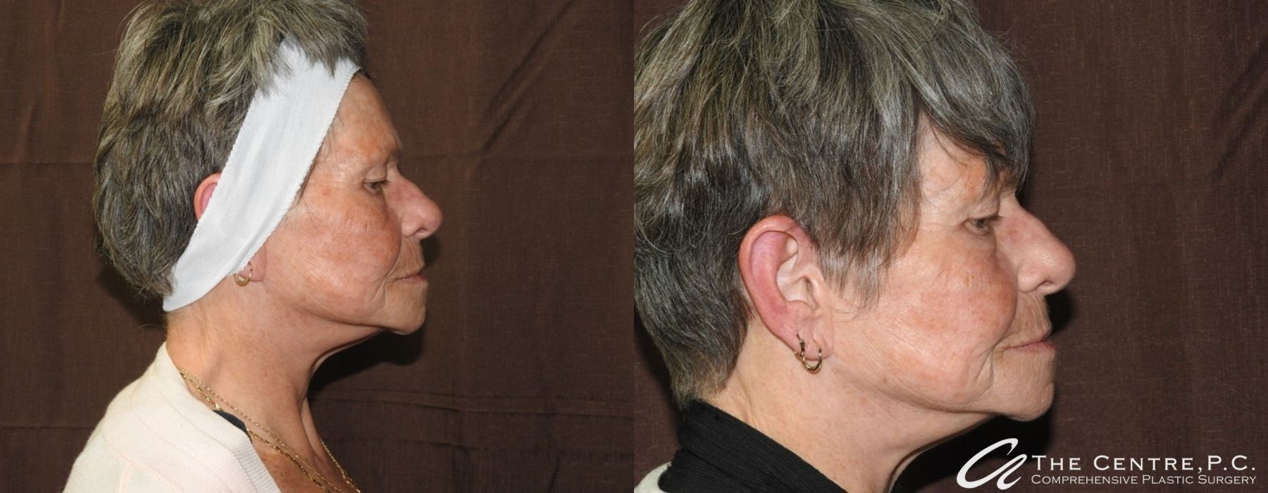 Facelift - Thumbnail 3