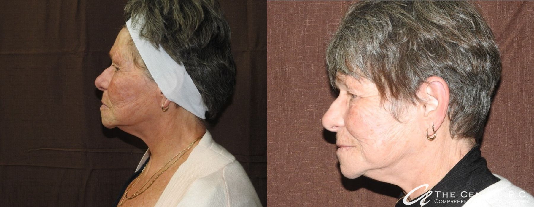 Facelift - Thumbnail 2